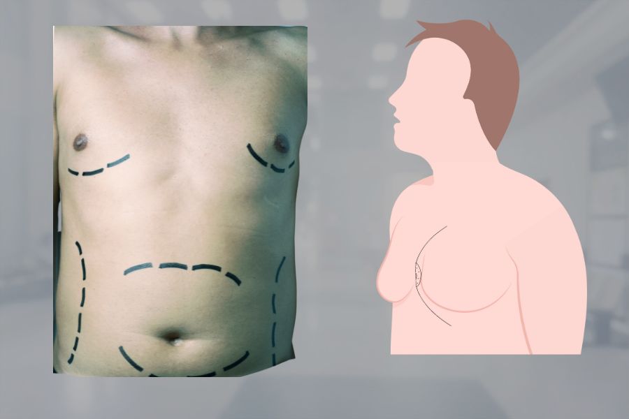 Gynecomastia Treatment in Bangalore